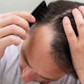 Injerto Capilar: La solución definitiva contra la pérdida de cabello